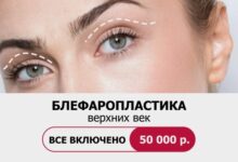 Photo of Что такое блефаропластика?